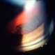 Intermediate Uveitis, Ciliary Body Cyst